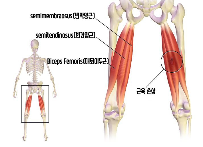 햄스트링 부상 축구 운동부상 운동 허벅지